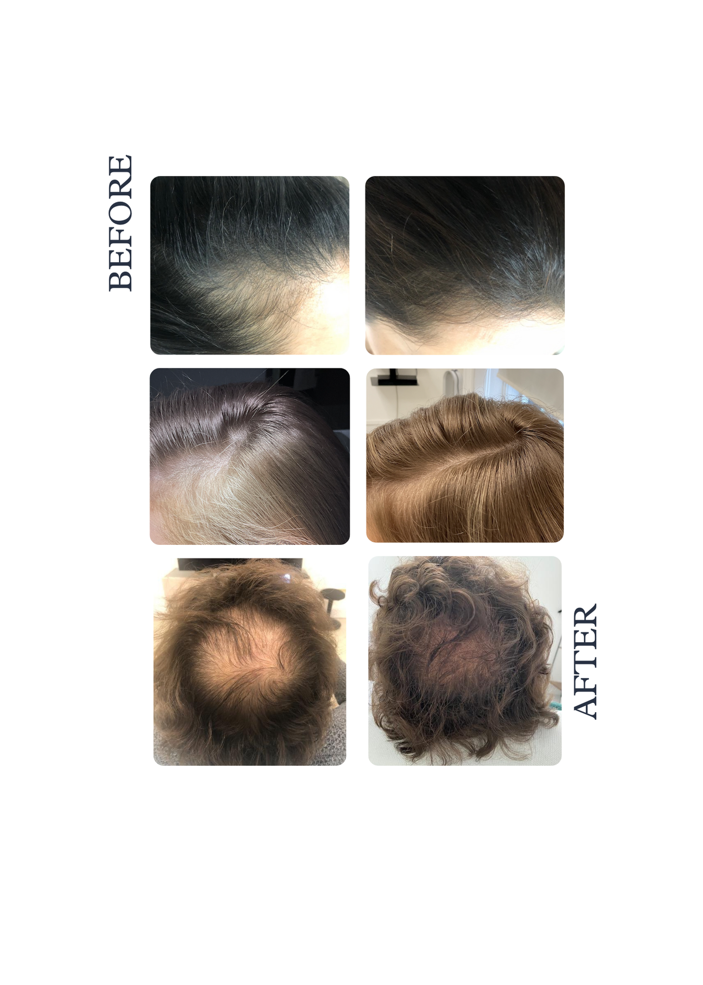 Soin contre la chute des cheveux