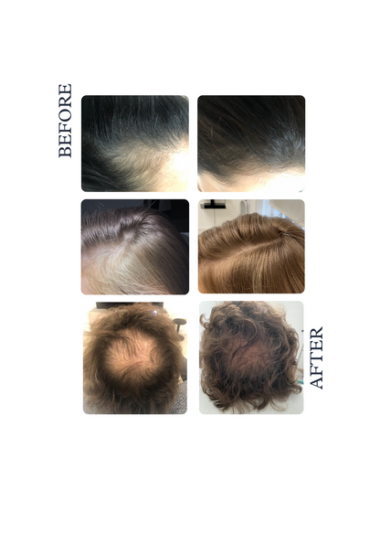 Soin contre la chute des cheveux